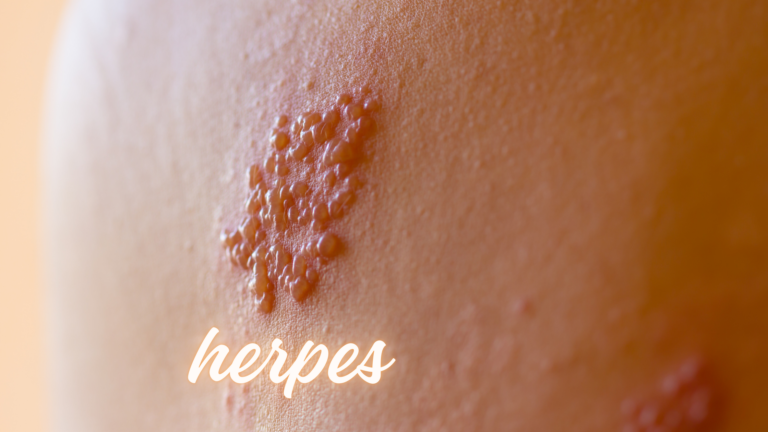 Herpes genital: O que você precisa saber
