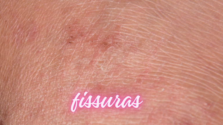 Fissuras vulvares: Principais causas e tratamentos  mais modernos