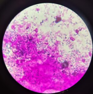 imagem com vaginose citolítica